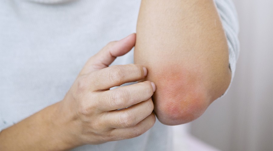 Eczema Affected Skin